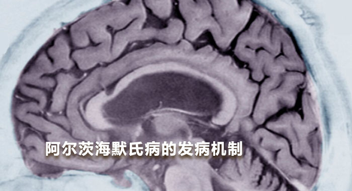阿尔茨海默氏病的发病机制(中文版)