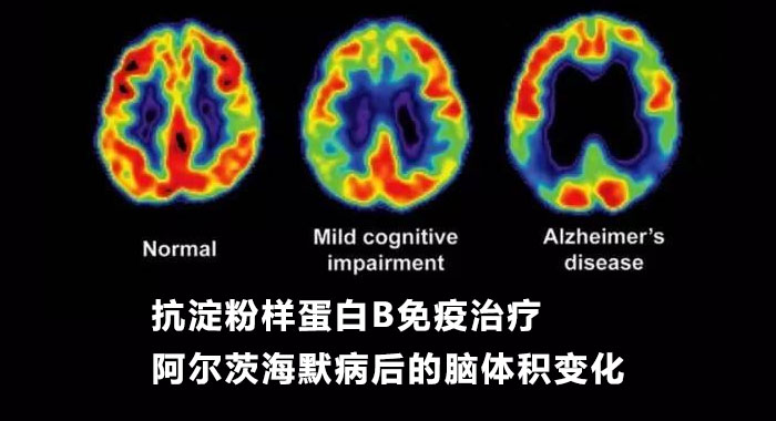 抗淀粉样蛋白β免疫治疗阿尔茨海默病后的脑体积变化：淀粉样蛋白去除相关的假性萎缩（英文）