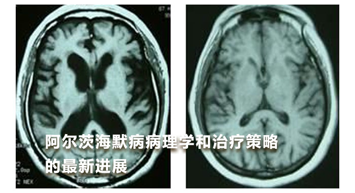 阿尔茨海默病病理学和治疗策略的最新进展（英文）