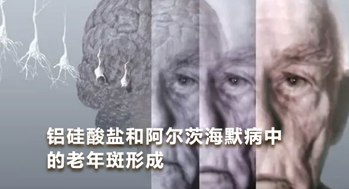 铝硅酸盐和阿尔茨海默病中的老年斑形成（英文）
