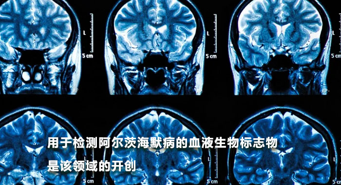 用于检测阿尔茨海默病的血液生物标志物是该领域的开创（英文）